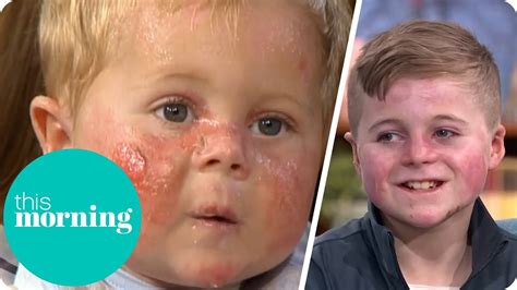 Boy With Butterfly Skin Returns 10 Years Later To Show Eamonn His