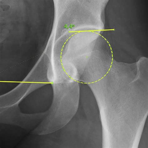 Sharps Angle Measurement On A Left Anteroposterior Hip Radiograph The