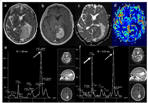 Lymphoma Conventional Mri Findings A B Axial T2w And Post Contrast