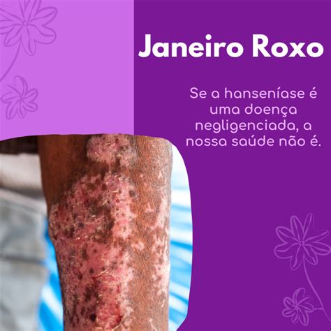 Dra Fernanda Lopes Dermatologia Blog Janeiro Roxo Hanseníase