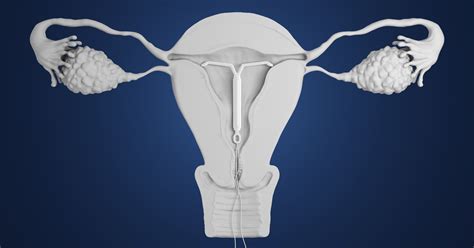 How Iuds Work The Different Types And What To Expect During And After