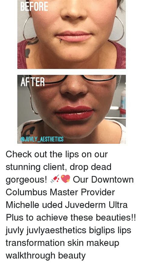 Before After Juvly Aesthetics Check Out The Lips On Our Stunning Client