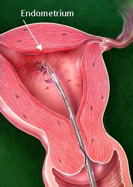 What signs or symptoms may make you suspect you may have endometrial cancer. D&C - VBGYN.com
