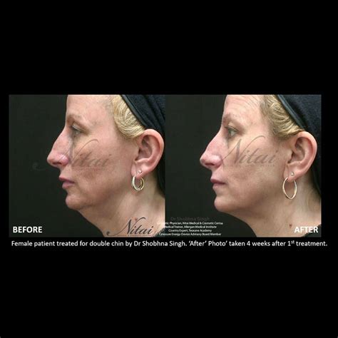 Double Chin Removal Injections Melbourne Nitai Clinic