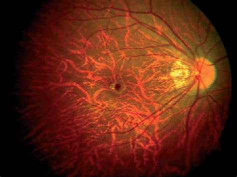 High Myopia Optometrist Paducah Kentucky Eye Doctor Paducah Ky