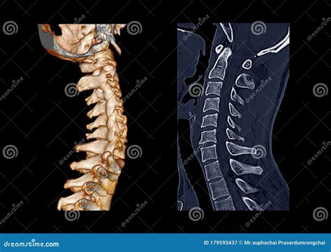 Compare Of Ct C Spine Or Cervical Spine 3d Rendering Image And Sagittal