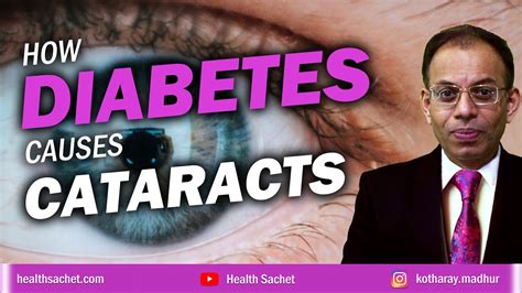 How Diabetes Causes Cataracts Youtube
