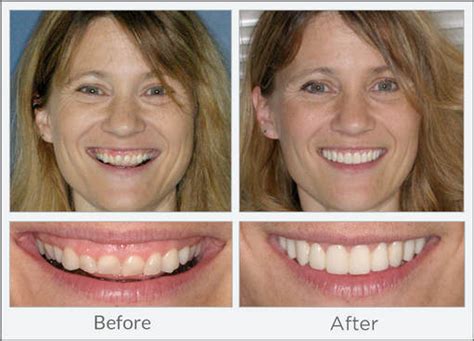 Gum Contouring Before And After Pictures Dental News Network