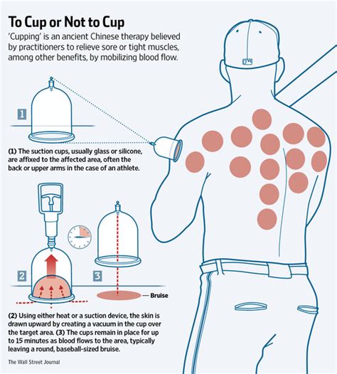 Mets Latch On To Cupping Therapy And Have The Marks To Prove It Wsj