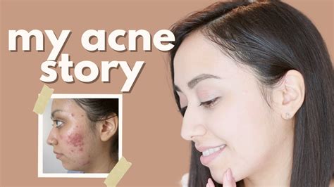 My Acne Story Journey To Clear Skin Part 13 Youtube