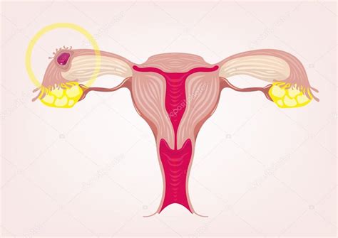 Ectopic Pregnancy Concept — Stock Vector © Crystaleyemedia 116837216