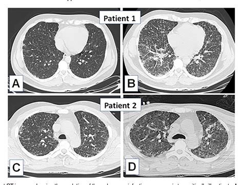 Figure 1 From Acute Pulmonary Histoplasmosis A Case Series From An