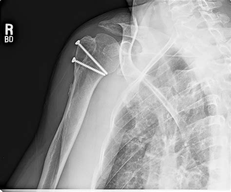 Shoulder And Elbow Surgery Proximal Humerus Fracture Dislocation 2