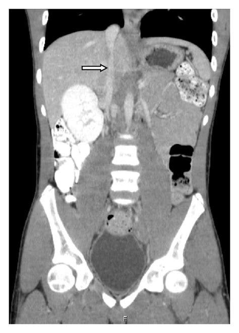 Contrast Enhanced Abdominopelvic Ct Scan Two Contiguous Coronal