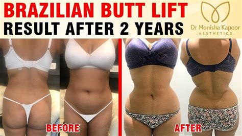 Brazilian Butt Lift Surgery The Latest Body Trend Result After 2 Yrs
