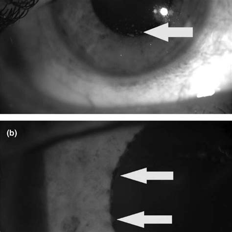 Eye Examination A Large Keratic Precipitates On The Corneal