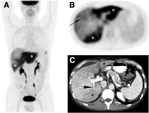 18f Fdg Petct Findings In Portal Vein Thrombosis And Liver Metastases