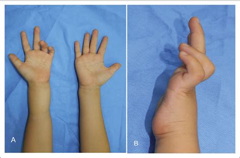 Figure 1 From Congenital Ulnar Nerve Deficient Hand A Case Report