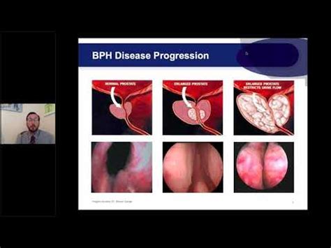 Dr Brian Mazzarella Webinar Enlarged Prostate And The Urolift Procedure Youtube