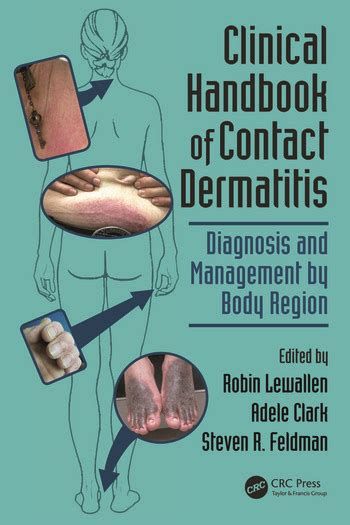 Clinical Handbook Of Contact Dermatitis Diagnosis And Management By