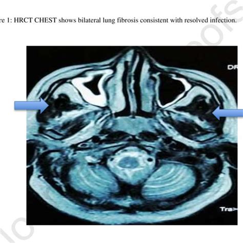 Mri Brain With Contrast Suggested Muco Inflammatory Changes At