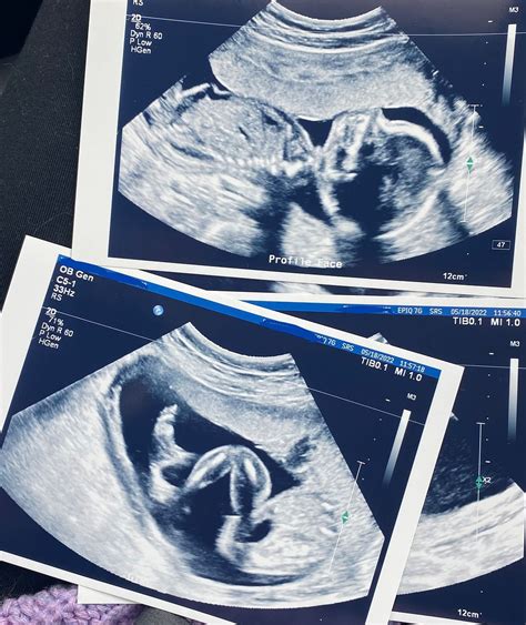 20 Week Ultrasound Picture Babycenter
