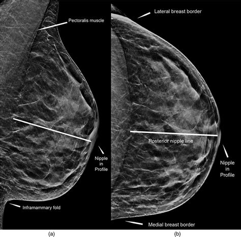 Illustration Of Positioning Criteria Of The Breast A Left Mlo View Download Scientific