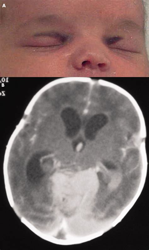 Palpebral Ecchymosis And Cerebral Venous Thrombosis In A Near Term