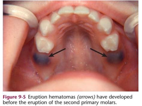 Ch9 Eruption Pediatric Dentistry Mcdonald