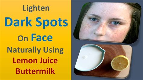 Lighten Dark Spots On Face Naturally Using Lemon Juice Buttermilk Youtube