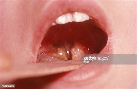Tonsillitis Stock Photos And Pictures Getty Images