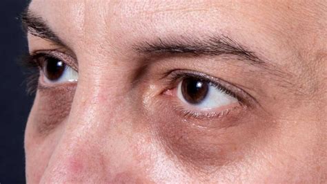 5 Causes For Dark Circles Under Eyes Marham