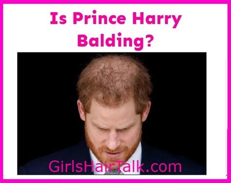 Is Prince Harry Bald What Happened To His Hair Prince Harry Bald