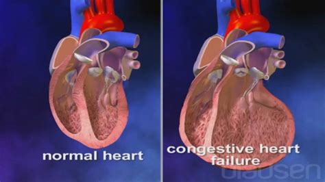 Congestive Heart Failure Prnewswire Conexión