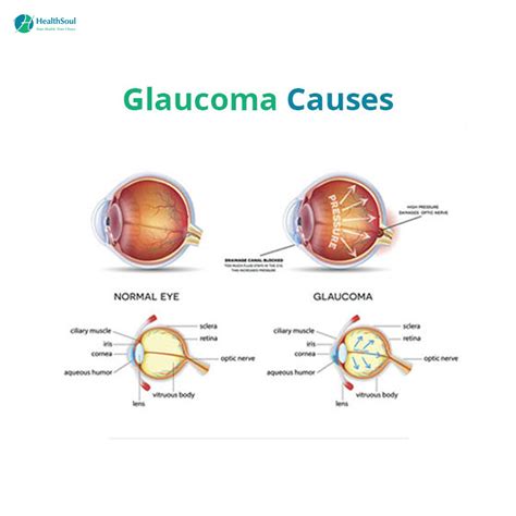 Glaucoma Symptoms Diagnosis And Treatment Healthsoul