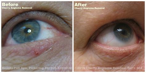 Cherry Angioma Removal Before And After Beauty Full Spa