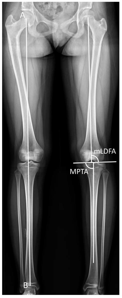 Jcm Free Full Text Tibial Lengthening Along Submuscular Plate With