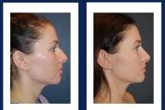 Nose Rhinoplasty Holzapfel Lied Plastic Surgery