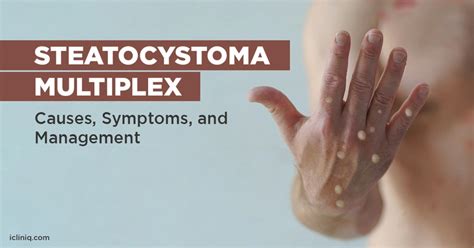 What Is Steatocystoma Multiplex