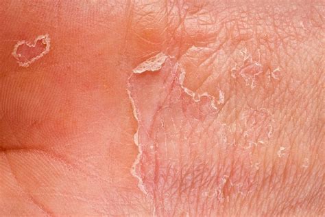 Dermatite Esfoliativa Causas Sintomas E Tratamentos Dicas De