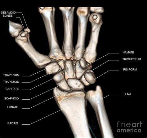 Normal Wrist Photograph By Zephyrscience Photo Library