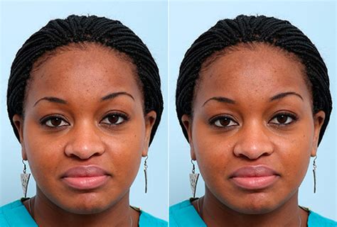 Buccal Fat Pad Removal Photos Houston Tx Patient 27873