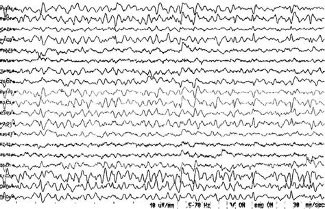 The First Eeg Examination Showing Diffusely Slowed Background Activity