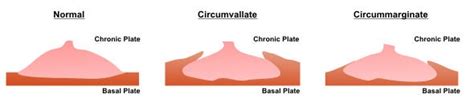 Circumvallate placenta is a placental morphological abnormality, a subtype of placenta extrachorialis in which the fetal membranes (chorion and amnion) double back on the fetal side around the edge of the placenta. What is the Placenta?
