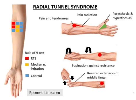 Radial Tunnel Syndrome RTS Anatomy And Clinical Examination Epomedicine