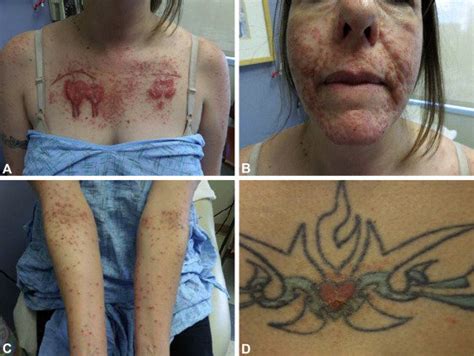 But these tattoos can cause severe allergic reactions. Allergic reaction to red tattoo ink and autoeczematization ...