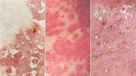 Psoriasis 101 Causes Symptoms Types And Treatment Everyday Health
