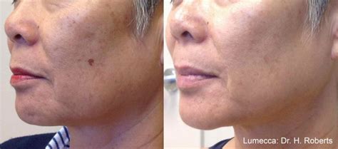 Lumecca Before And After Stone Springs Medspa By Lmg