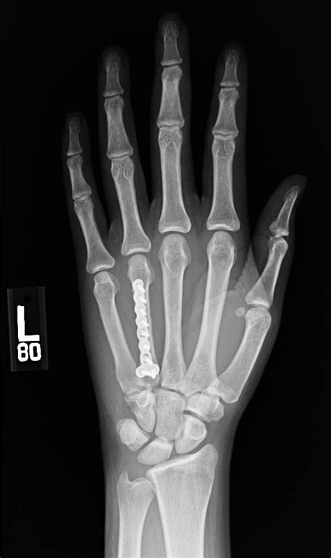 Hand Fractures Common Hand Injury Dr Gordon Groh