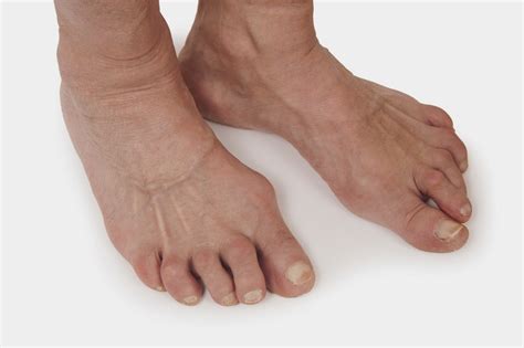 Arthritishq Rheumatoid Arthritis In Feet